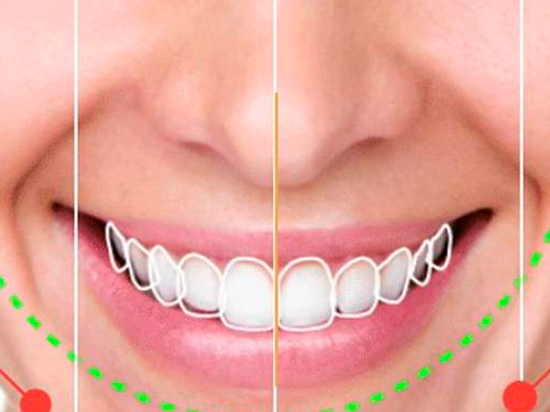 ¿Qué es el diseño de sonrisa?